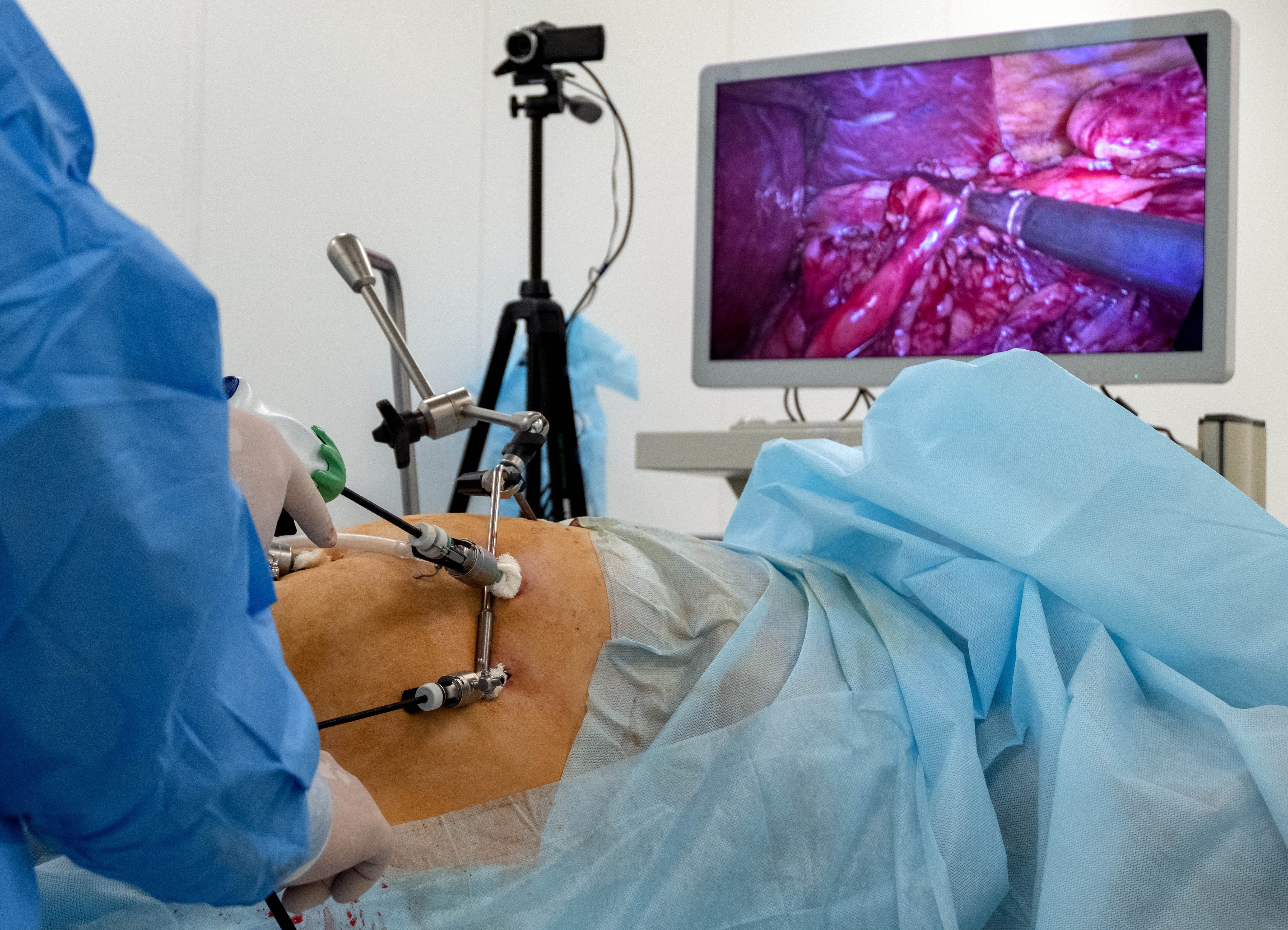 Laparoscopic-hernia-repair-surgery